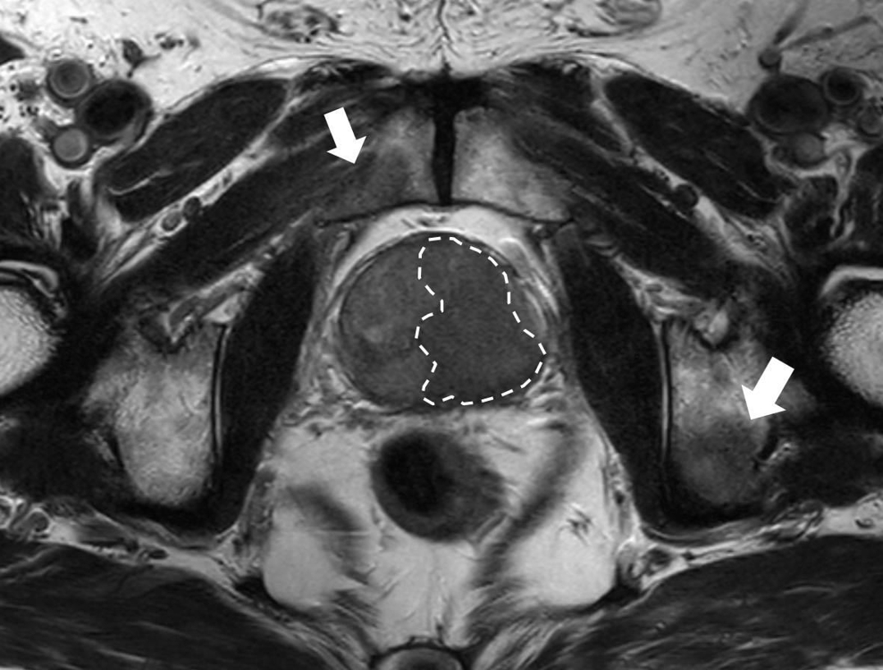 PSA 수치가 5.780ng/㎖인 77세 남성 환자의 MRI 이미지