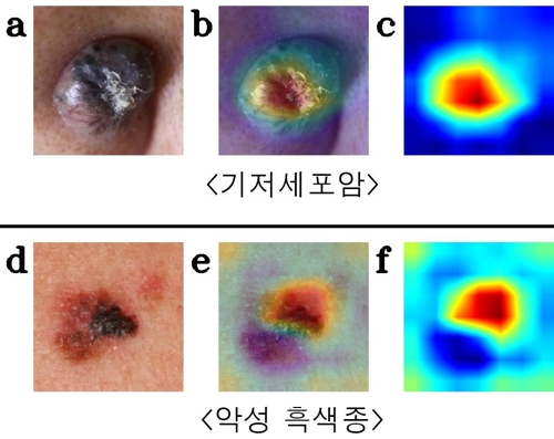피부암 '악성 흑색종' AI로 조기 진단…"정확도 90%" - 1