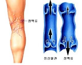 하지정맥류
