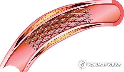 스텐트