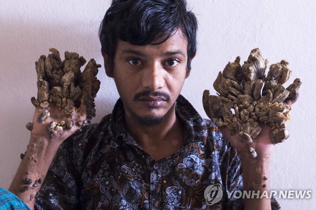BANGLADESH-HEALTH-TREEMAN