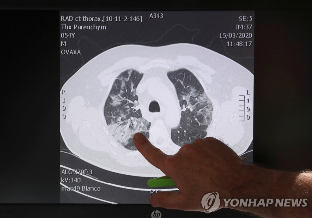  15일 벨기에의 한 병원 의료진이 코로나19 환자의 CT 이미지에서 손상된 폐 부위를 가리키고 있다. 