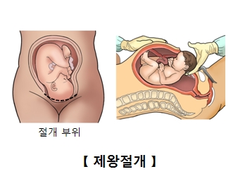 제왕절개 분만