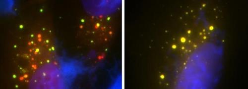 난치성 ALS 치료를위한 초록불?  세포 스트레스를 조절하는 효소 발견