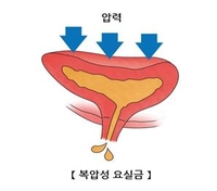 "요실금, 여성 정신건강에도 영향"