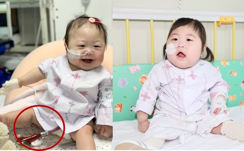 VAD를 달고 있는 육수진 환아의 사진(왼쪽)과 심장이식 수술 후 퇴원을 앞둔 사진(오른쪽) [세브란스병원 제공]