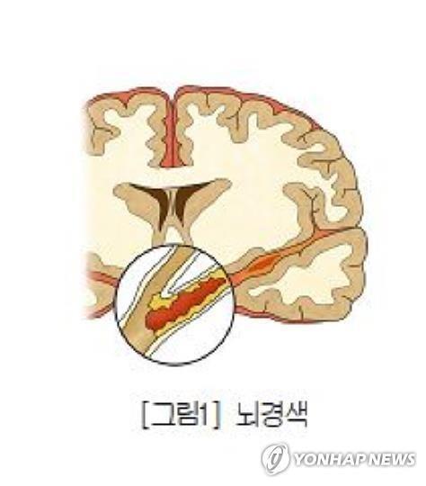 뇌경색