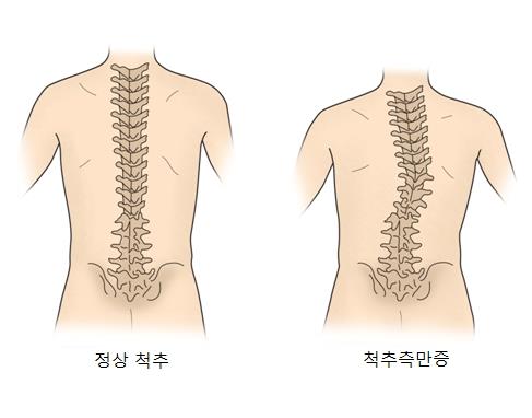 척추 측만증