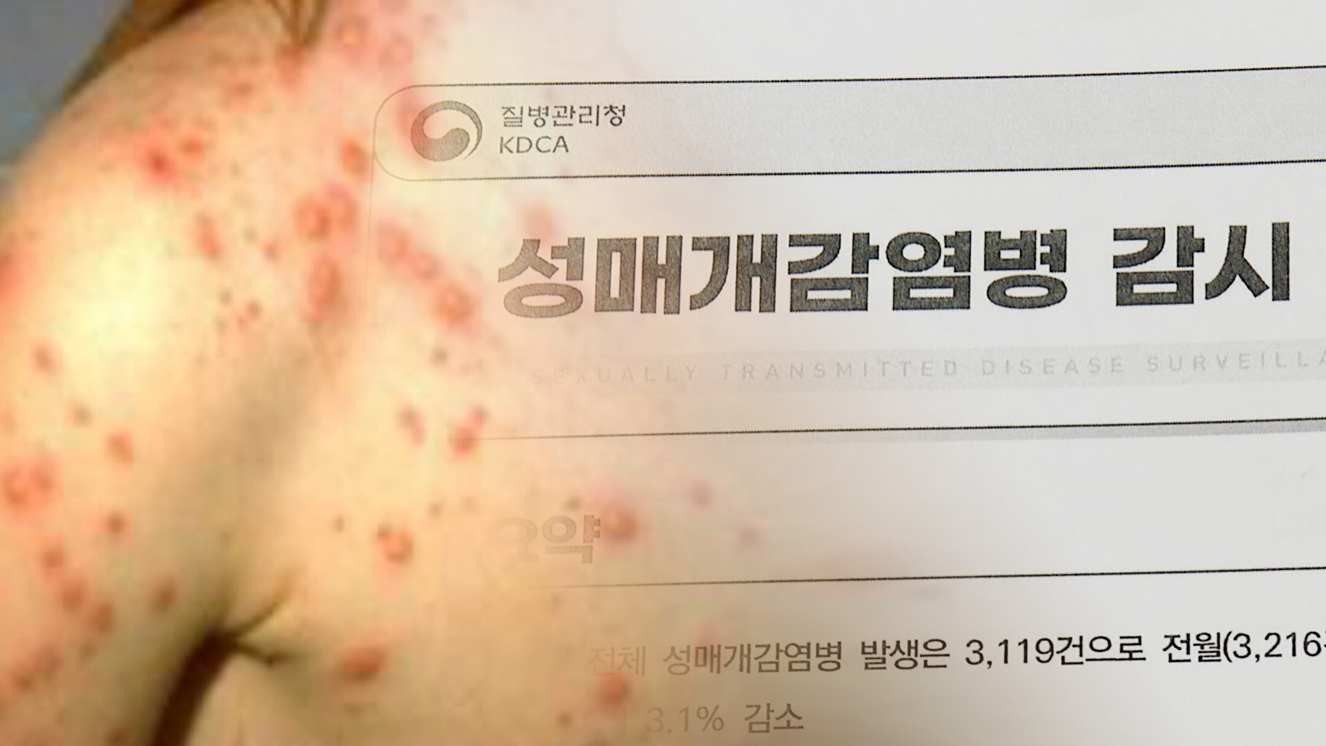 늘어나는 매독 감염… 늘어나는 매독 감염…