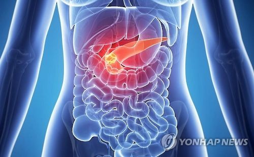 "한국인 췌장암 부르는 3대 위험요인은 흡연·비만·당뇨병"