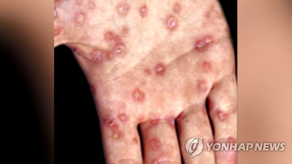 작년에도 역시…매독 환자 2천790명 중 