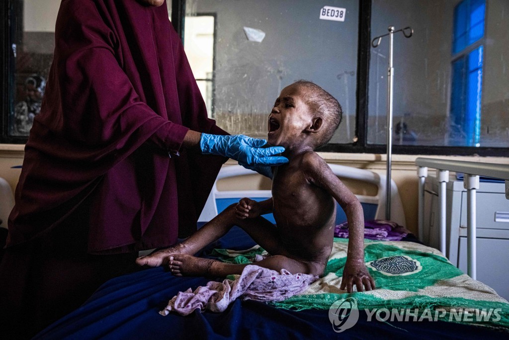 영양 부족에 시달리는 소말리아 아이